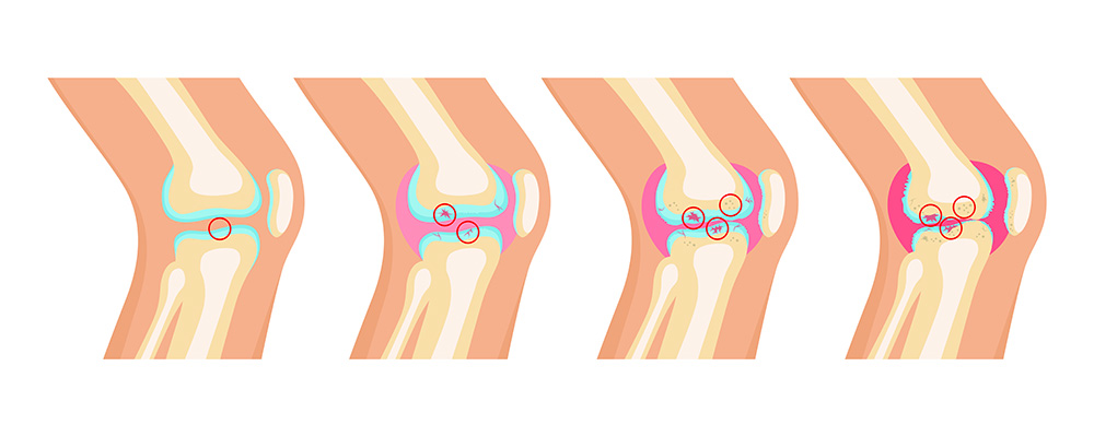 Bone Marrow Lesion Treatment Dr Patrick N Bays